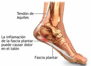 Fascitis Plantar