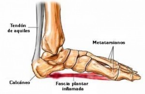 fascitis-plantar