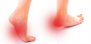 fascitis_plantar_fisioterapia playamar