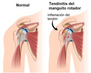 tendinitis manguito rotador, tendinitis de hombro