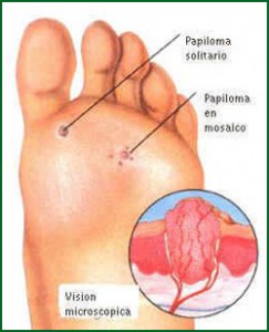 papiloma, podologia